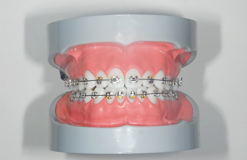 歯並びの治療